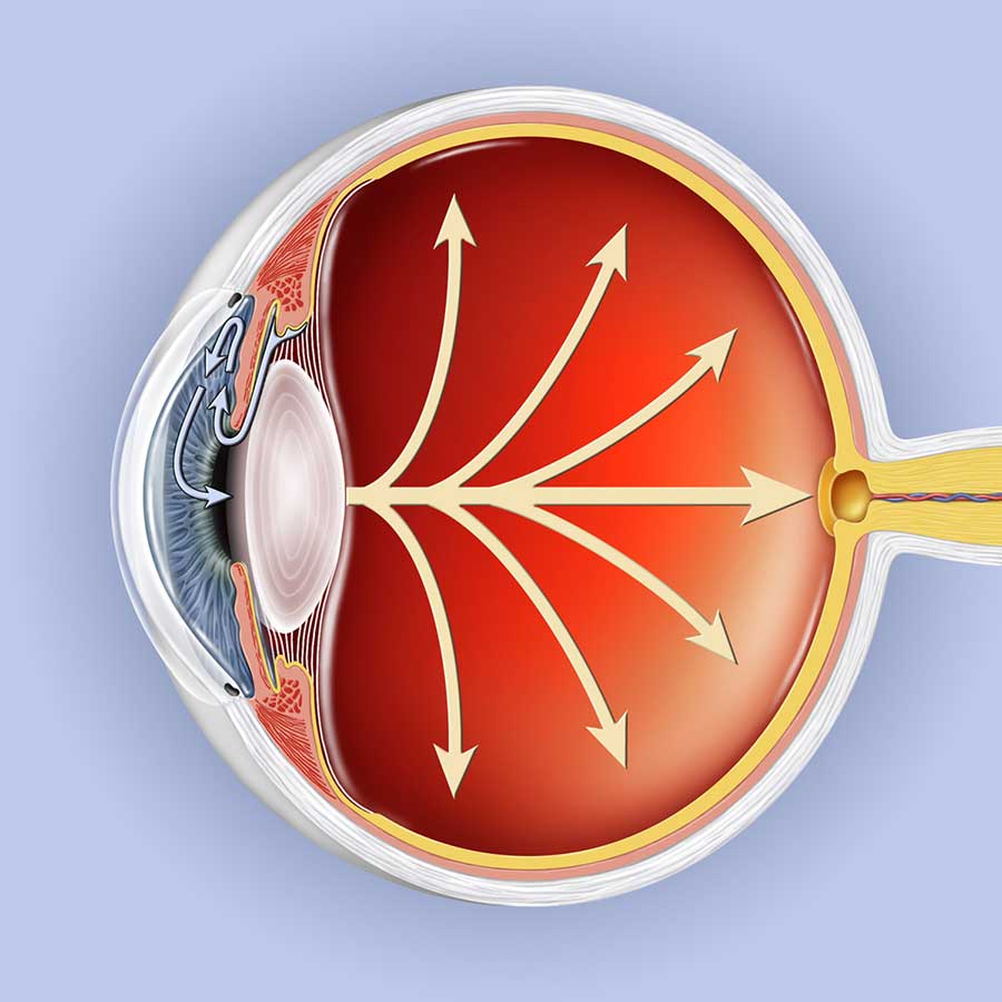 WHAT IS GLAUCOMA